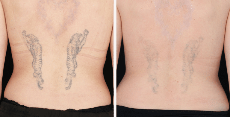 How Much Does Laser Tattoo Removal Cost