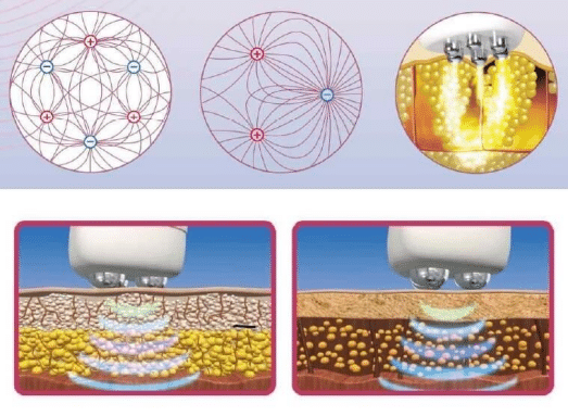 How does Multipolar RF work?