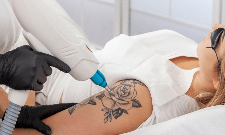 Can Laser Tattoo Removal Cause Cancer?