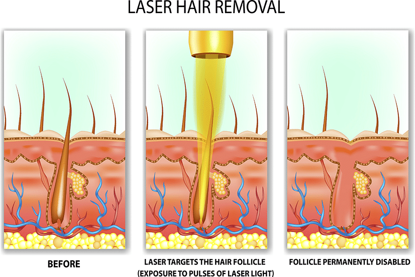 Comment fonctionne l'épilation au laser?