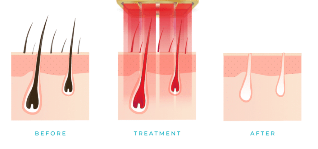 Procédure d'épilation au laser