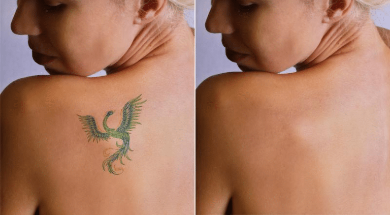 Will My Skin Go Hack to Normal After Laser Tattoo Removal?