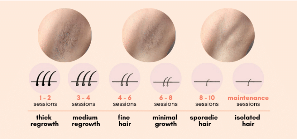 Results of Laser hair removal