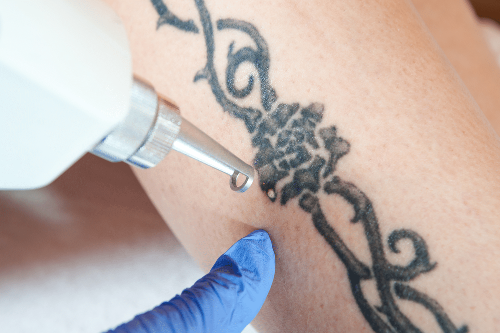 Can tattoo be removed completely by lasers