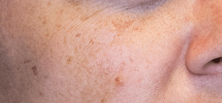 How Long does Pigmentation Begin to Fade After Laser Treatment?