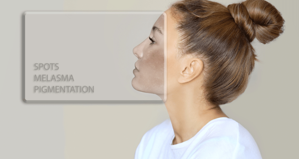 How long does pigmentation begin to fade after laser treatment